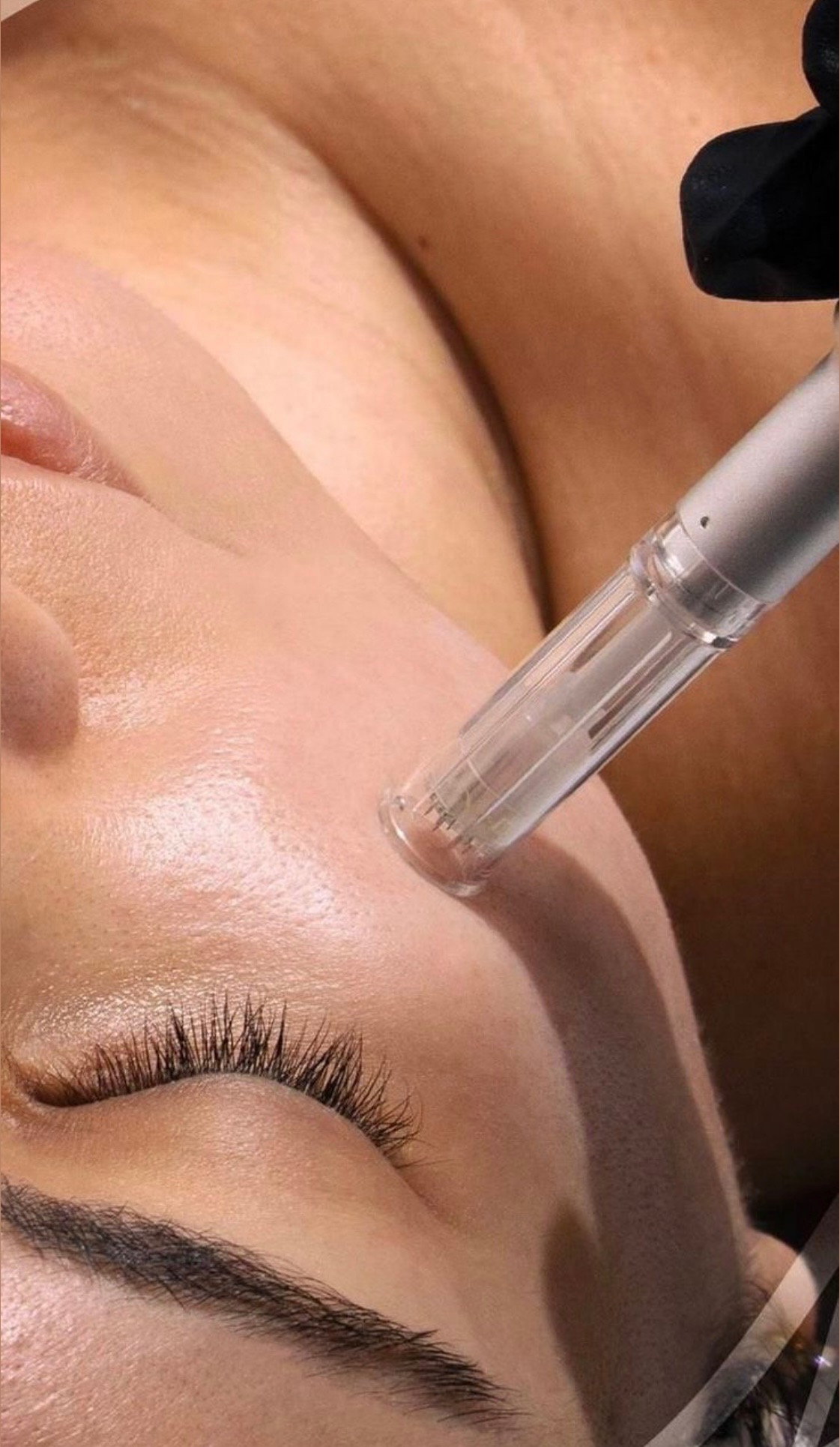 BioRePeel Cl3 + Microneedling 